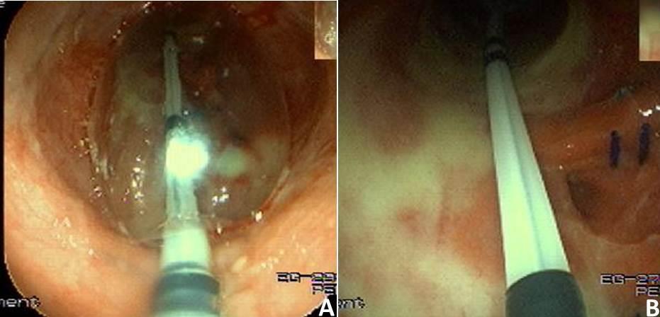 10 Imagens endoscópicas do paciente n o 12: A) Mucosectomia de uma parte do septo usando alça de