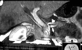 Fig.4 Fig5 Fig. 5 Figs. 4, 5 - Interesse actual das reconstruções 3D: paciente com colangiocarcinoma intrahepático do lobo direito e trombose do ramo direito da veia porta (fig 4).