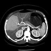 opacificação arterial não sendo possível discernir se existe ou não infiltração por contiguidade do segmento IV; fig 5b): a reconstrução com algoritmo MIP mostra o simples desvio da veia hepática