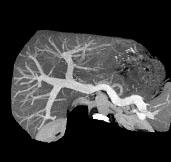 Em primeiro o alargamento do feixe de radiação X para irradiar as múltiplas filas de detectores e o uso rotineiro de aquisições multifase fazem com que a dose de radiação recebida pelo paciente