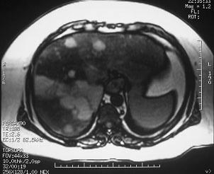 pseudo-lesões hepáticas focais diagnosticados por outras técnicas, em especial ecografia e TC, que, ao não demonstrarem anomalias de sinal nas ponderações T1 e T2, podem ser confidentemente