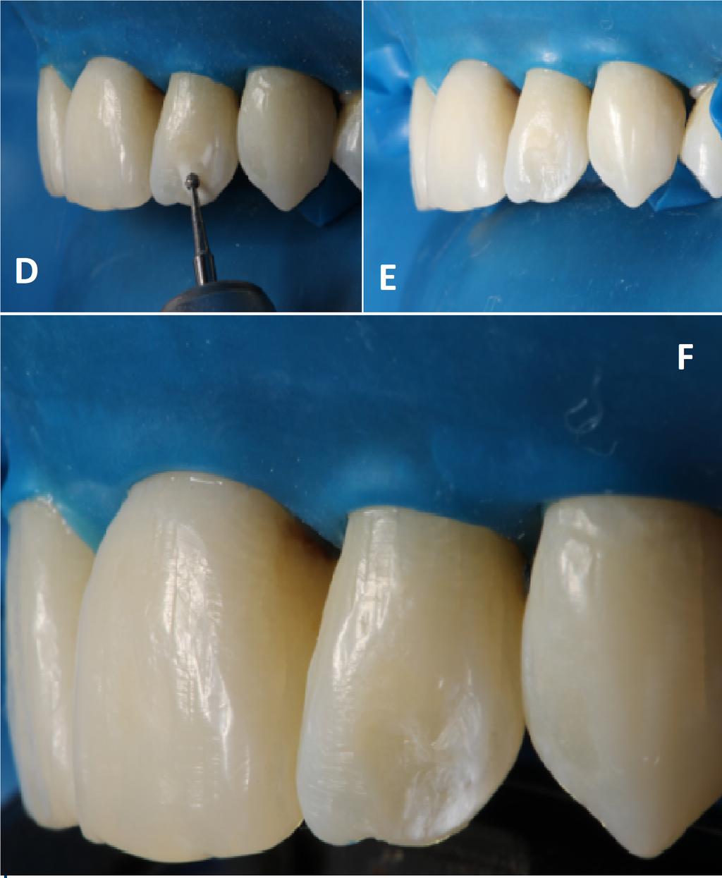 Figura 1 - Sorriso inicial vista frontal (A) e lateral (B)(C) Figura 2 - Remoção da lesão hipoplásica com ponta esférica diamantata nº 1012 (D) e vista do dente preparado sem a lesão (E) e final após