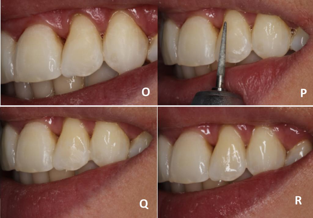 Figura 6- Vistal frontal - Caso finalizado