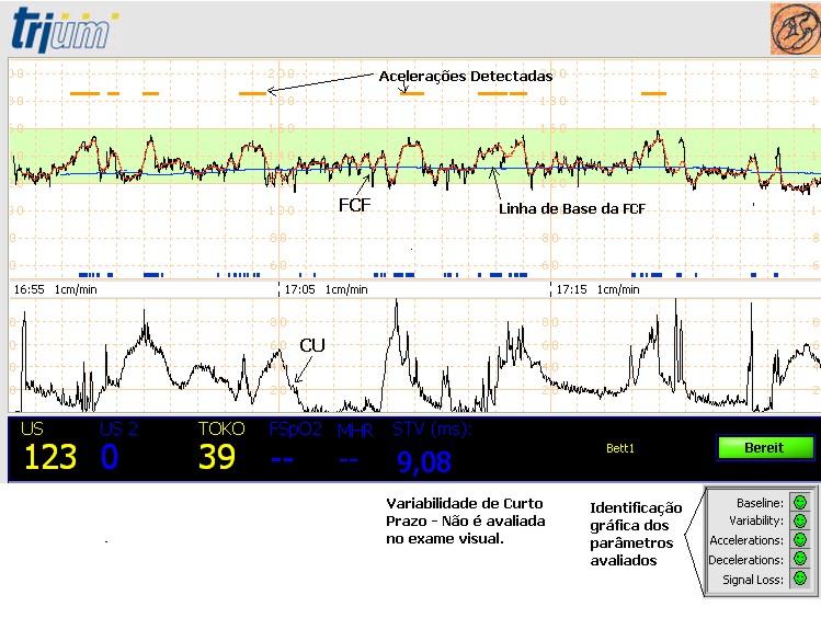 Capítulo 2: Monitoramento Fetal 28 Figura 2.5: CTG interpretada pelo programa CTGOnline. nos próprios traçados do exame.