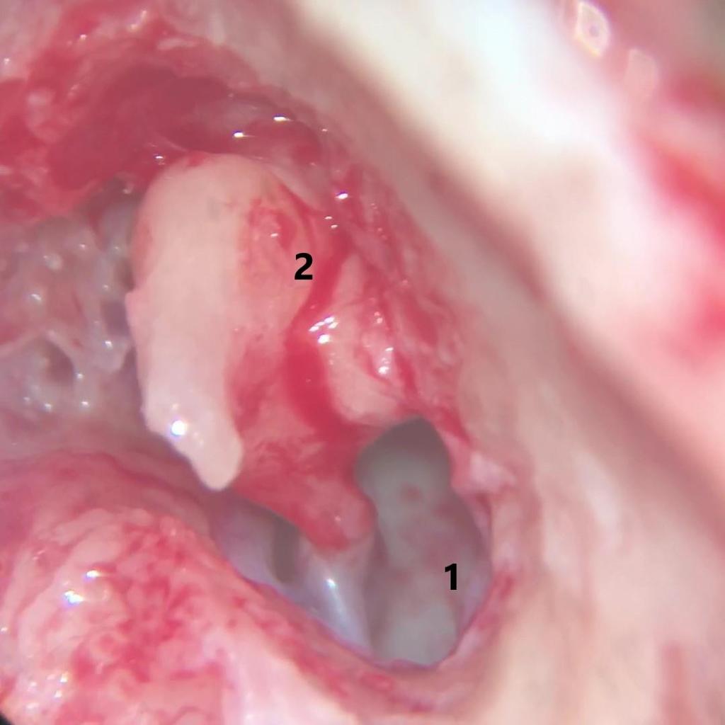 5 Resultados 47 Figura 8 - Timpanotomia posterior com destaque para a cadeia ossicular malformado e fundida (fusão incudomaleolar) Passo 5 Confecção do Nicho: