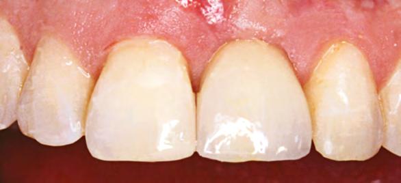 Quando se trata da substituição de um dente posterior também podemos usar a tecnologia CAD/ CAM tanto para coroas cimentadas ou parafusadas sobre implantes.