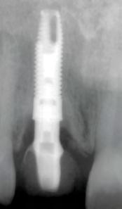 raiz (A). Implante P.I. Branemark (B).