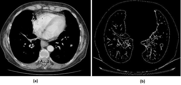 APLICAÇÃO 2: REDE VGG Problema: detecção de nódulos pulmonares CT