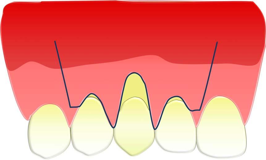 Materiais e Métodos 23 Ambos grupos foram tratados com ADMG *, com tamanho padronizado (10 mm x 10 mm), como um enxerto subepitelial e com o mesmo desenho de incisão (Fig. 2).