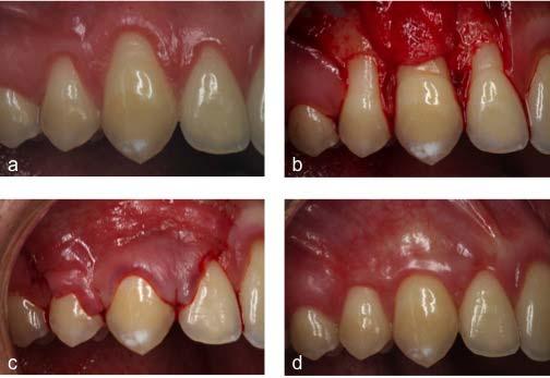 Materiais e Métodos 25 Fig. 4. Sequência clínica do grupo teste. (a) Retração gengival pré-operatória em canino maxilar direito.