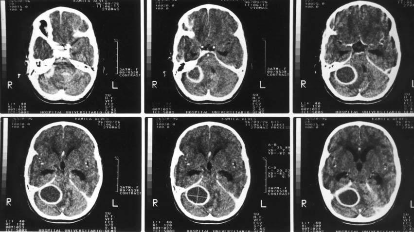 Arq Neuropsiquiatr 2001;59(3-B) 825 ig 1. TC de admissão (26/09/96): abscesso cerebelar à direita, secundário a mastoidite crônica. ig 2.