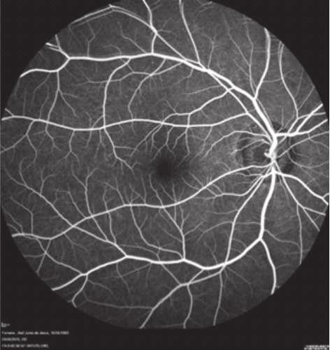 (11) A SD-OCT é uma nova modalidade da imagem latente para permitir a imagem OCT de alta resolução de camadas externas da retina e da coroide (modo de EDI).