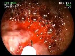 Quadro Clínico: A hemorragia digestiva alta (HDA) geralmente se