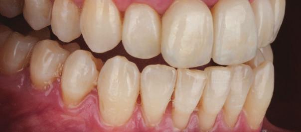 Stains translúcidos para replicar a translucidez da incisal e cervical. Pastas de estrutura para criar textura e pequenas correções.