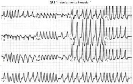 Figura 7 ECG com taquicardia de complexos QRS irregularmente irregular, representando uma FA com resposta ventricular rápida em doente com VA. Retirado e adaptado de Sethi KK et al., (2007) 21.