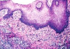 Em contrapartida, o Grupo II (Novocol 100) apresentava trabeculado ósseo mais delgado e maior quantidade de tecido conjuntivo inter-trabecular, demonstrando que o atraso na cronologia do processo de