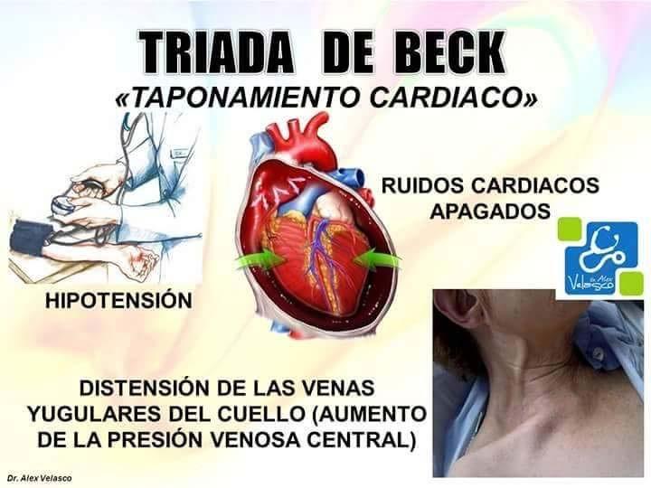 cardíaco: arritmias, ruptura valvar, morte súbita.