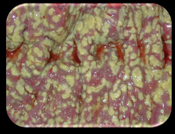 Microbiota no tratamento 1958* - Colorado (EUA): quatro pacientes criticamente comprometidos com colite pseudomembranosa fulminante 2000 Cepas multirresistentes de C.