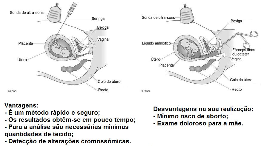 BIÓPSIA DE VILOSIDADE CORIÔNICA