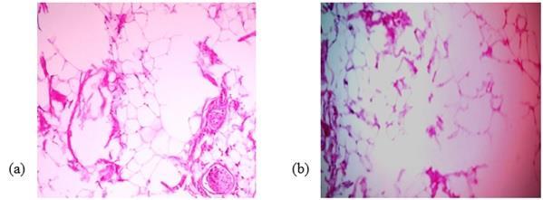 Figura 3 - Fotomicrografia de tecido adiposo suíno tratado com Lipofocus mostrando destruição de adipócitos - HE 40x. a: Amostra de tecido adiposo tratada com Lipofocus (A2).