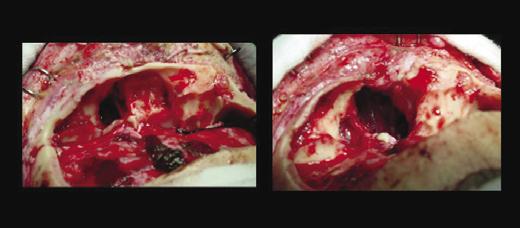 Paciente masculino, branco, 38 anos, com deformidade facial progressiva apresentava na TC uma lesão displásica na porção antero-medial da órbita direita e nasal homolateral (Fig. 7 Esq ).