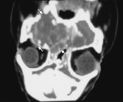 FIGURA 4 -. Reconstrução coronal da tomografia computadorizada.