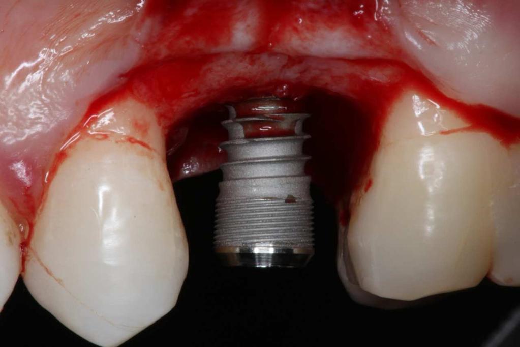 divulsão do retalho mucoperiostal, confecção da loja cirúrgica e inserção do implante osseintegrado (Figura 2 e 3).