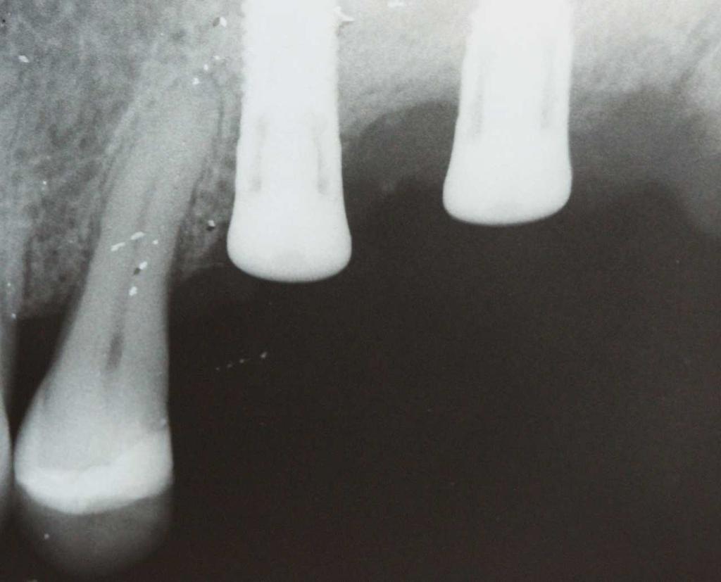 21 Figura 4 Imagem radiográfica de implantes com cicatrizadores. Figura 5 Imagem radiográfica de implante com o SmartPag.