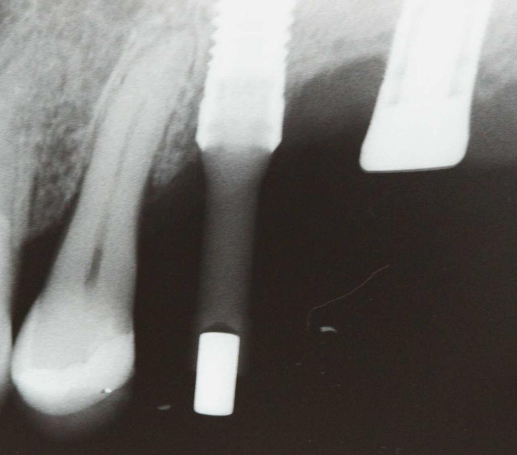 Os implantes que tiveram medições acima de 70 Ncm foram numericamente considerados com 80 Ncm e os abaixo de 30 Ncm foram considerados 20 Ncm para os dados estatísticos.