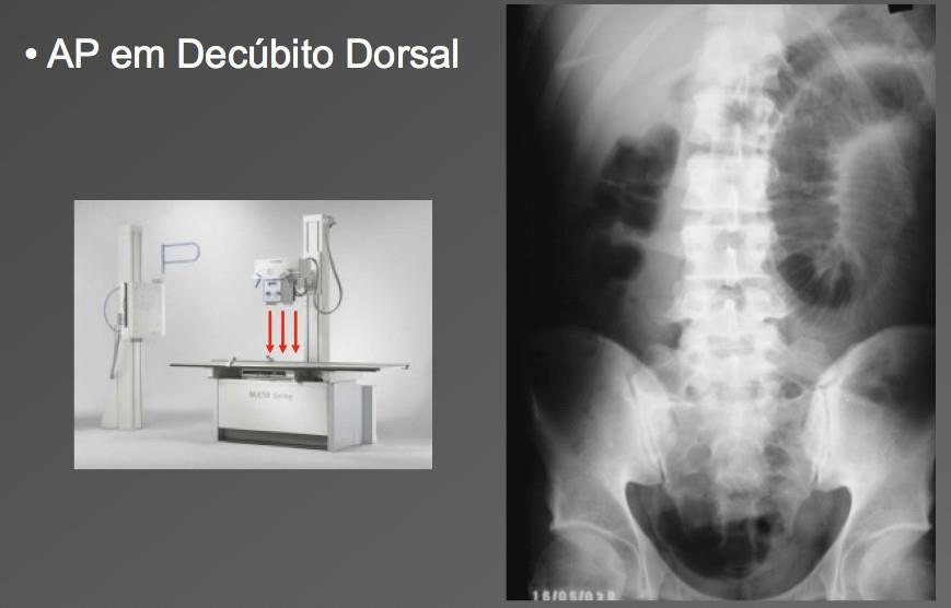 MÉTODOS DE IMAGEM PARA AVALIAÇÃO DO ABDOME: 1) RADIOLOGIA CONVENCIONAL - Radiografia simples de