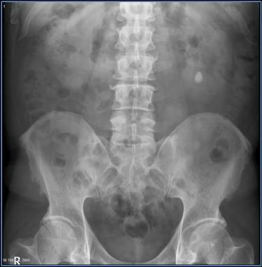 MÉTODOS DE IMAGEM PARA AVALIAÇÃO DO ABDOME: 1) RADIOLOGIA CONVENCIONAL - Indicações frequentes: A)