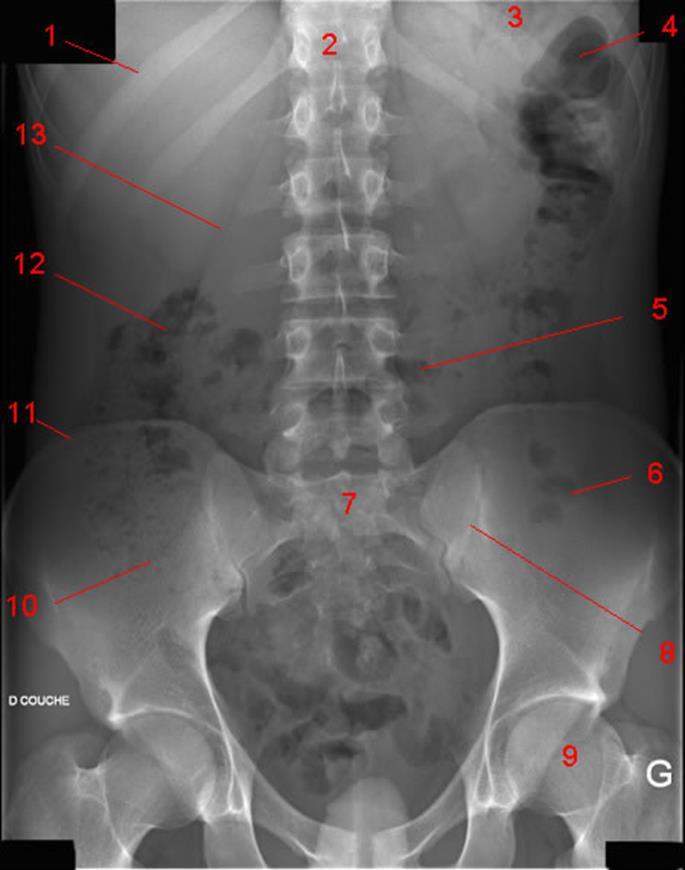 AVALIAÇÃO DO CONTEÚDO ABDOMINAL RADIOGRAFIA SIMPLES DE ABDOME: - Atenção sistemática: ossos,