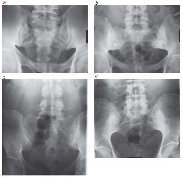 AVALIAÇÃO DO CONTEÚDO ABDOMINAL RADIOGRAFIA SIMPLES DE ABDOME: - Atenção sistemática: ossos, tecidos moles, bases pulmonares, órgãos