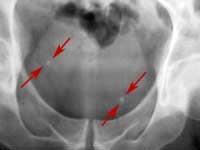 duodenal, flexura hepática e esplênica do cólon e ampola retal)