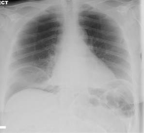 radiografia de tórax?