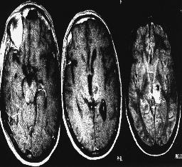 Arq Neuropsiquiatr 1998;56(3-B) 667 RELATO DO CASO Paciente do sexo masculino, de 27 anos de idade, com história de déficit motor progressivo iniciado no membro superior direito (D), seguido de