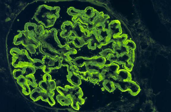 Antimembrana basal glomerular (porção