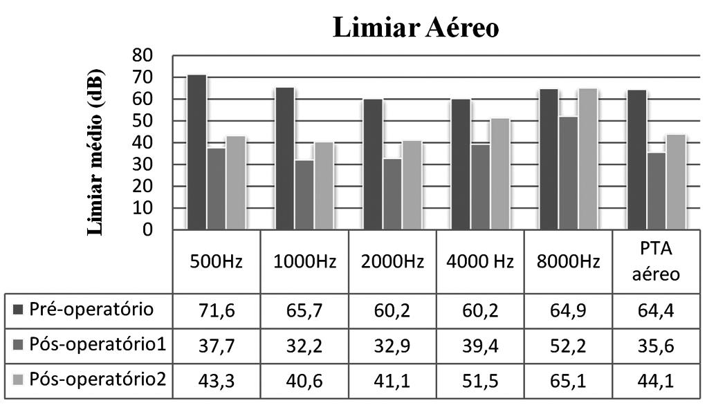 O sintoma de apresentação mais frequente foi a hipoacusia bilateral (61,7%), isolada (29,8%) ou acompanhada de acufeno (31,9%). A duração mediana dos sintomas foi de 72 meses (1-300 meses).