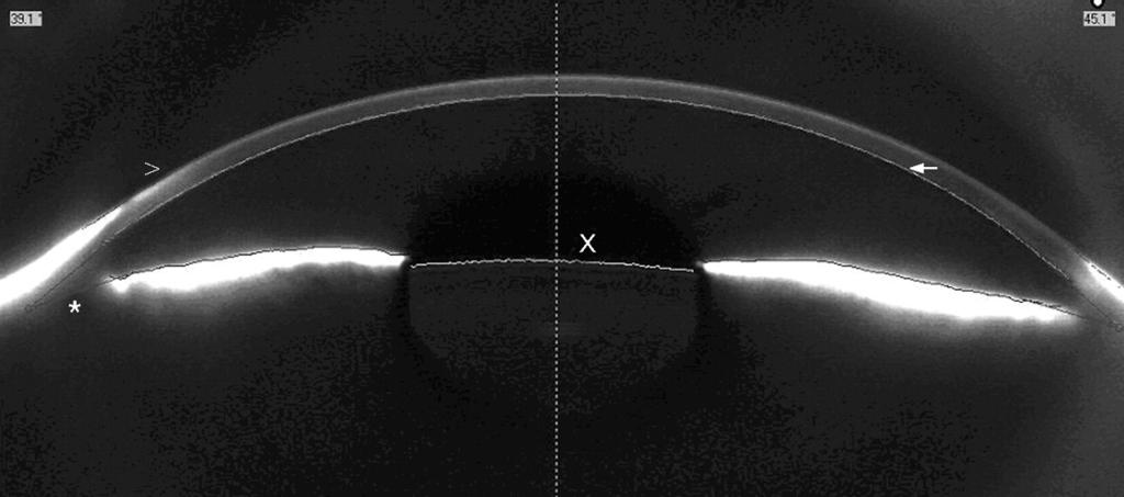 António Melo AVALIAÇÃO DO SEGMENTO ANTERIOR NO GLAUCOMA GONIOSCOPIA