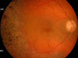 5) PTOLOGIS HRITÁRIS TÓXIS RTINOPTI PIGMNTR aracteriza-se por uma atenuação arteriolar, palidez do disco óptico e espículas ósseas na média periferia retiniana.