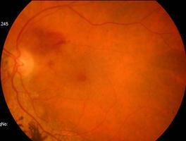 principais veias retinianas.