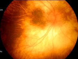 OROIRÉMI istrofia coroidea que se inicia na mádia periferia da retina.