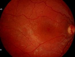 RTINOSQUIS LIG O X istrofia retiniana em jovens do