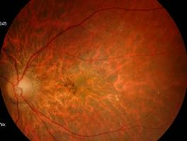 . STRGRT É a distrofia macular mais comum.