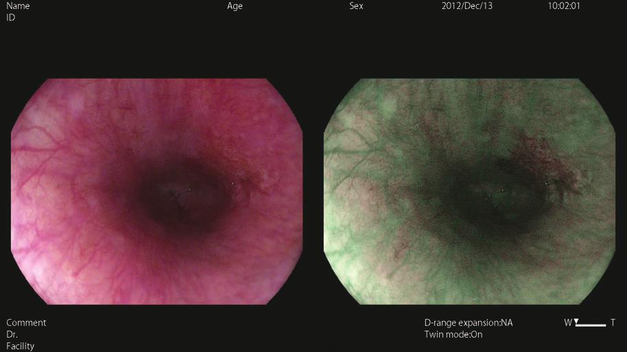 HD Além disso, o uso de um endoscópio de magnificação óptica em conjunto com o OE do 1 permite a observação de uma A EPK-i7010 fornece imagens HD nítidas, claras e brilhantes, permitindo a