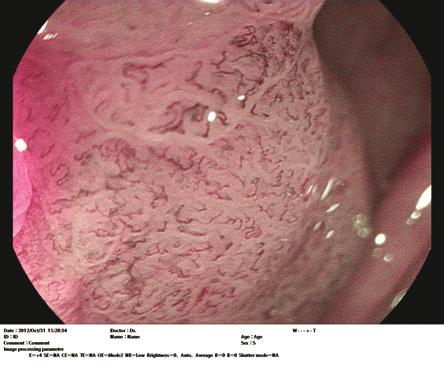 Luz Branca CE (Realce de Contraste): O modo CE baseado em software permite o realce de microirregularidades (textura) identificando áreas escuras nas imagens e posteriormente realçando as cores com