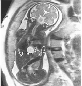 1 A HDC normalmente ocorre no lado esquerdo (cerca de 90%), sendo o estômago, intestino delgado e cólon as estruturas que ficam inseridas na cavidade pulmonar.