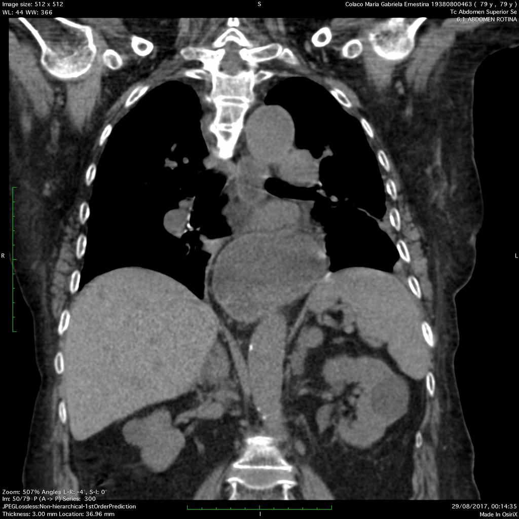 2. Causas de elevação diafragmática II- DOENÇA ABDOMINAL Figura 6: