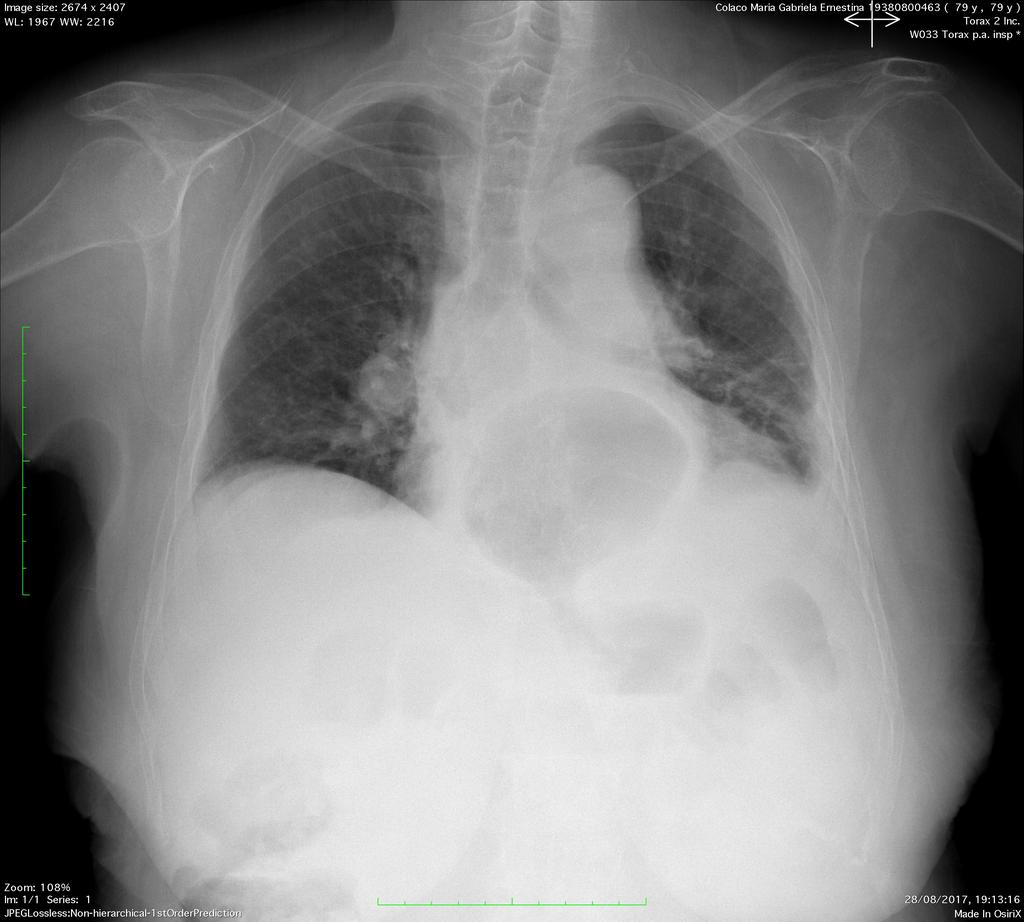 intratorácica condicionando elevação da hemicúpula diafragmática e