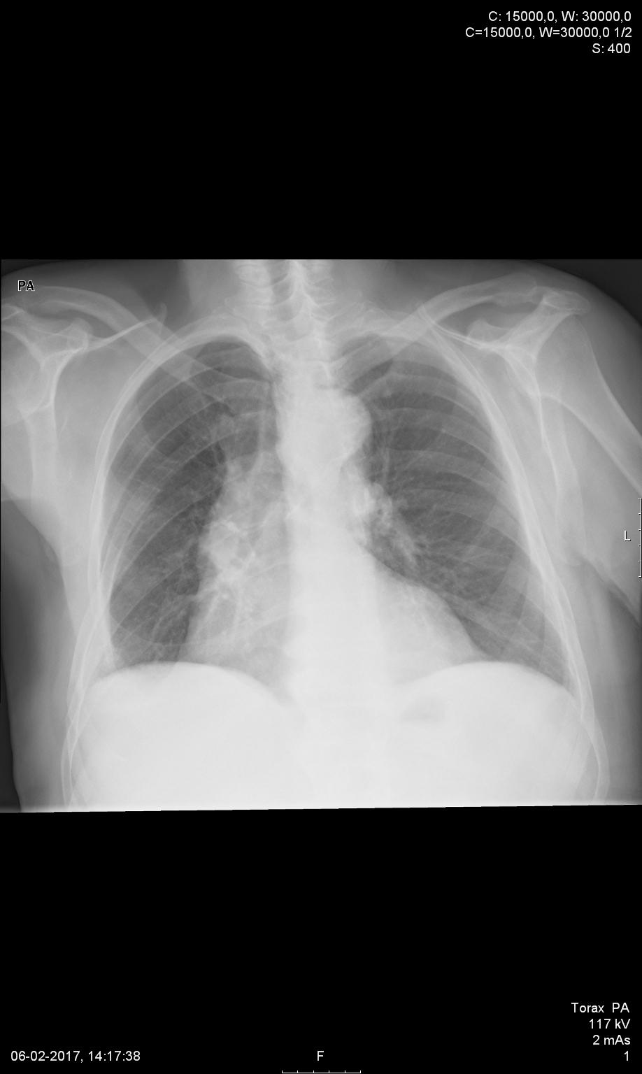 2. Causas de elevação diafragmática III- ALTERAÇÃO DO VOLUME PULMONAR Figura 7.